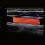 Chison SonoTouch 50 (SonoAir)
