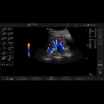 GE Healthcare Versana Active Портативный УЗИ аппарат — изображение 10