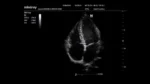 Клиническое изображение Mindray M6_ 2P2s_Cardiac_4C_B_1