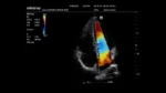 Клиническое изображение Mindray M6_ 2P2s_Cardiac_4C_CFM_1