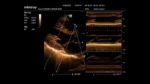 Клиническое изображение Mindray M6_ 2P2s_Cardiac_4C_Free-Xross-M_1