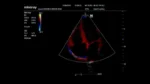 Клиническое изображение Mindray M6_ 2P2s_Cardiac_4C_TVI_1