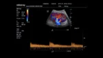 Клиническое изображение Mindray M6_ 3C5s_Kidney_CFM
