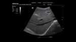 Клиническое изображение Mindray M6_ 3C5s_Liver_B_3