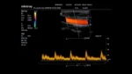 Клиническое изображение Mindray M6_ 7L4s_Carotid_PW_1