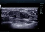 Клиническое изображение на УЗИ аппарате Mindray Resona 6_ фиброаденома молочной железы