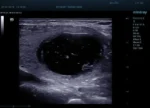 Клиническое изображение на УЗИ аппарате Mindray Resona 6_ объемное образование щитовидной железы