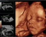 Клиническое изображение УЗИ-аппарат Mindray Resona 7_ лицо эмбриона, 3D