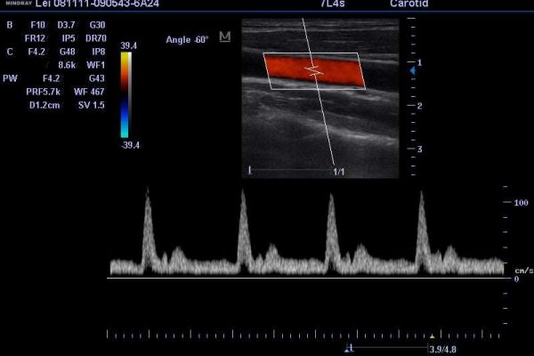 Mindray M5