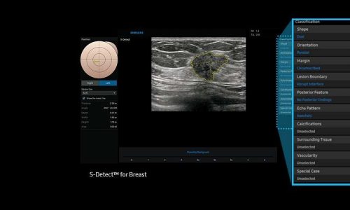 sdetector-breast-img