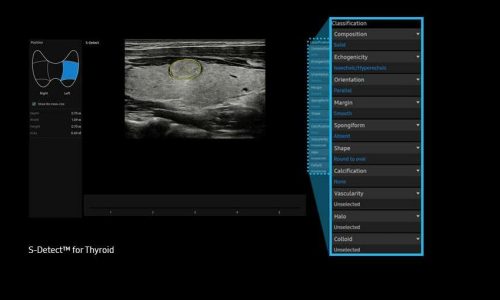 sdetector-thyroid-im
